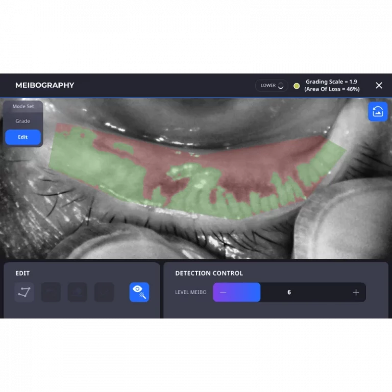 2.2 Multi-Angle Comprehensive Dry Eye Diagnosis