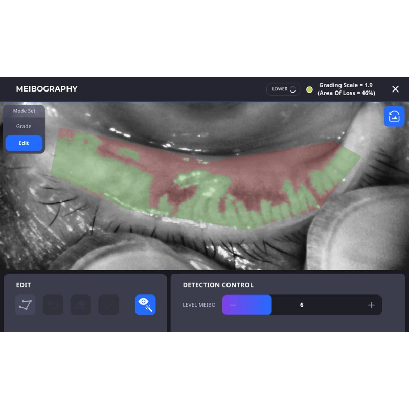 2.2 Multi-Angle Comprehensive Dry Eye Diagnosis